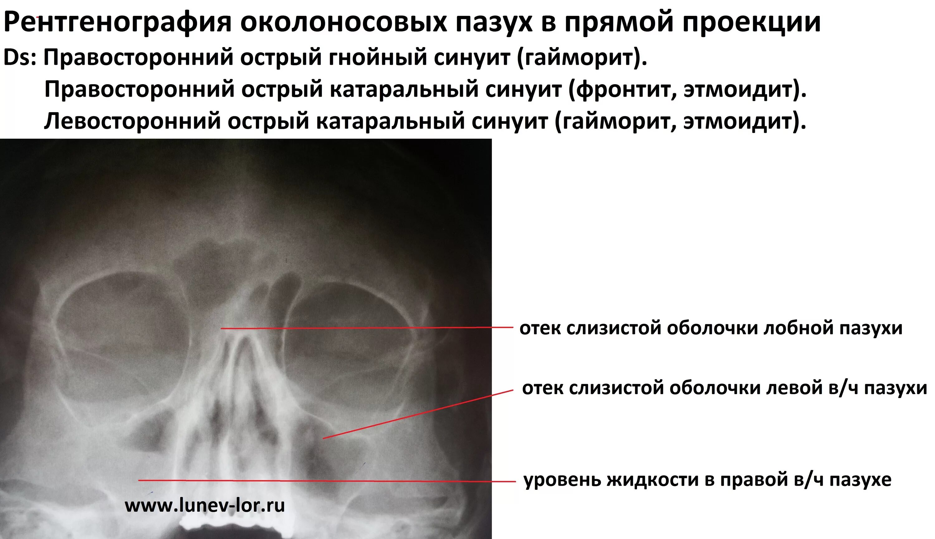 Рентген гайморовых пазух норма. Рентген придаточных пазух носа синусит. Рентген пазух носа фронтит. Описание рентгенограммы носовых пазух. Пристеночный отек слизистой