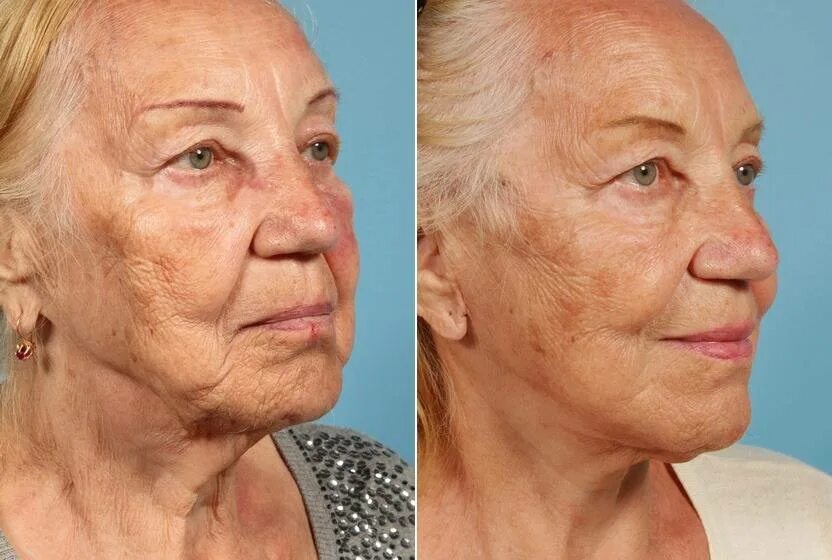 Возрастные изменения 60 лет