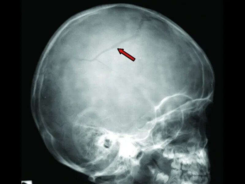 Оскольчатый перелом черепа рентген. Перелом основания черепа рентген. ЧМТ перелом затылочной кости. Перелом свода черепа рентген. Трещина черепа у ребенка