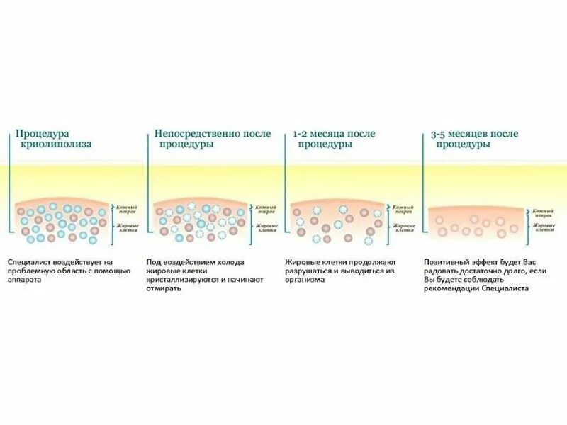 Криолиполиз что это отзывы. Процедура криолиполиз схема. Рекомендации после криолиполиза. Принцип действия криолиполиза. Криолиполиз рекомендации после процедуры.