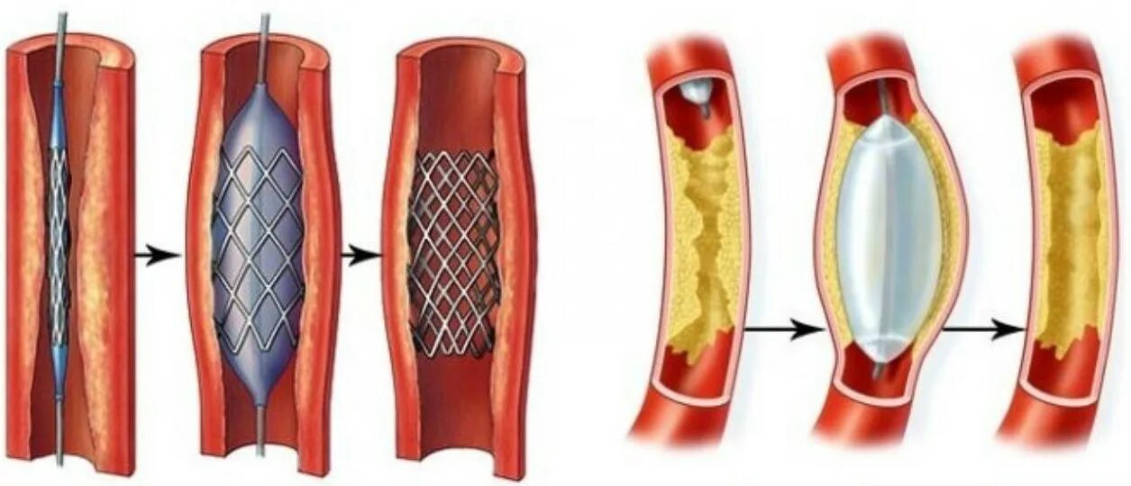 Операция при атеросклерозе сосудов. Баллонная ангиопластика и стентирование. ТРАНСЛЮМИНАЛЬНАЯ ангиопластика сосудов. Баллонная ангиопластика коронарных артерий. Коронарная ангиопластика и стентирование.