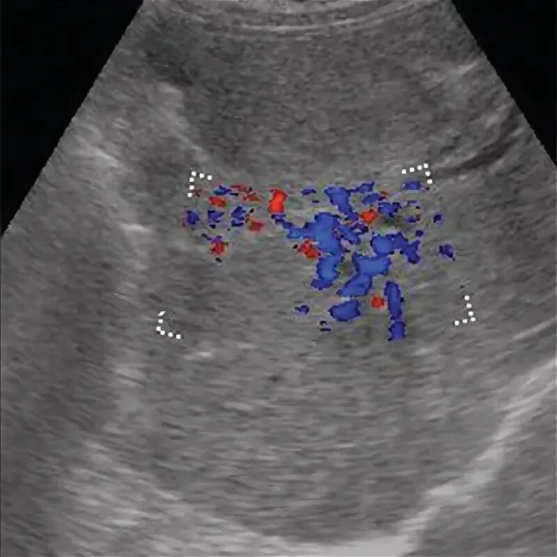 Кавернома воротной вены. Кавернозная трансформация воротной вены на УЗИ. Ангиоматоз воротной вены. Тромбоза вен печени