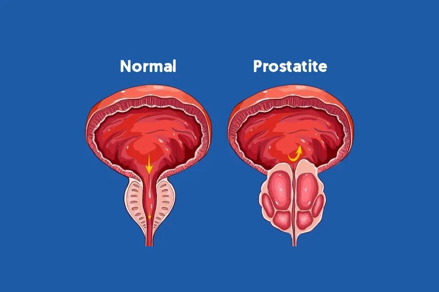 Что значит простатит. Острый и хронический простатит. Простата у мужчин. Заболевания предстательной железы.