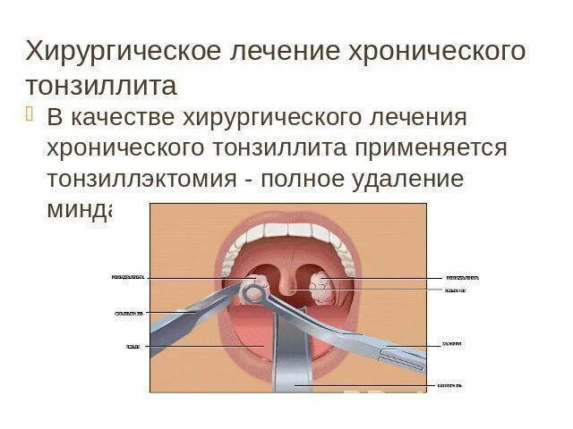 Тонзиллит хронический лечение народная. Хронический декомпенсированный тонзиллит. Хронический тонзиллит памятка. Обострение хронического тонзиллита.