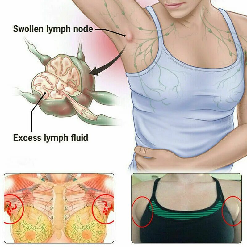 где расположены лимфоузлы под мышками. где расположены лимфоузлы под мышками. воспалился лимфоузел под мышкой. схема лимфоузлов под мышкой. лимфатические узлы под мышкой.
