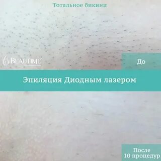 Тотальная эпиляция что это