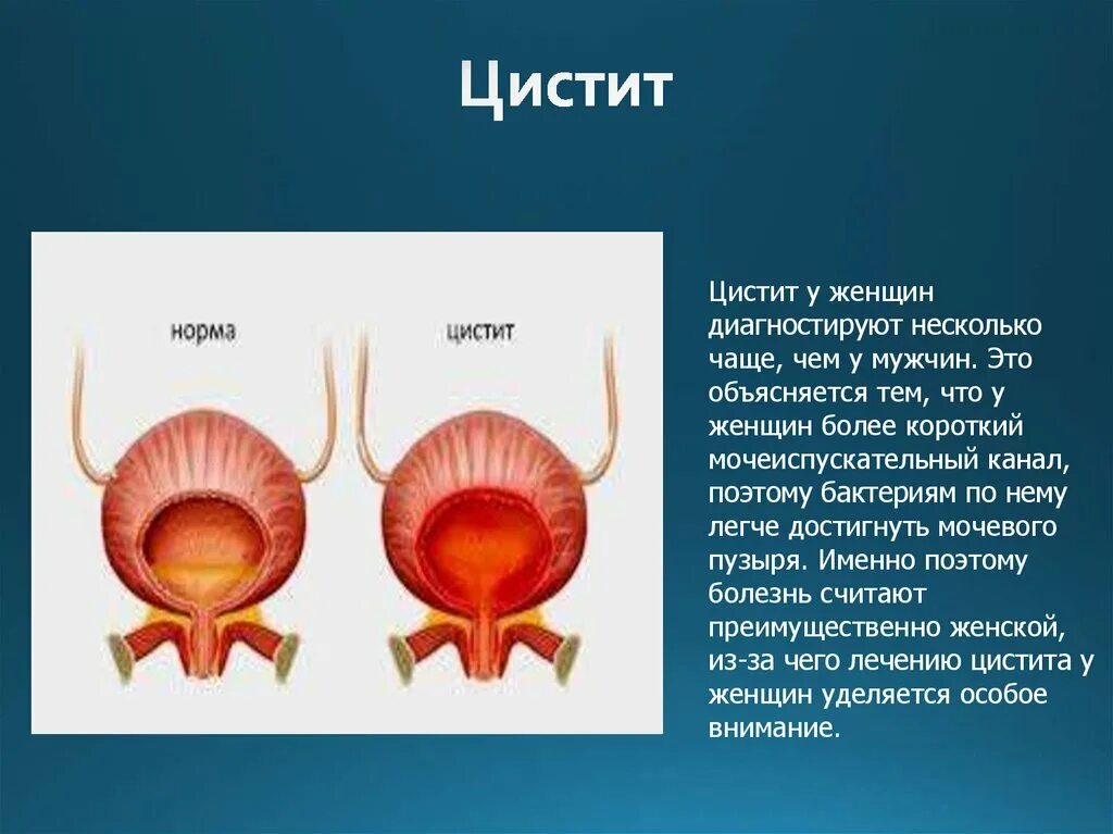 Мочеполовые болезни у мужчин симптомы лечение. Воспалительные заболевания органов мочевой системы. Неспецифические воспалительные заболевания мочеполовой системы. Заболеваний мочеполовой системы презентация. Неспецифические заболевания органов мочеполовой системы.