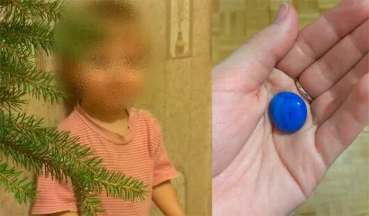 Обзорный рентген брюшной полости. Ребенок съел камень. Ребенок съел камень. Если ребенок проглотил камень. Инородное тело в желудке рентген.
