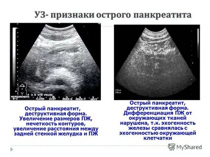 Эхографические признаки изменения почек