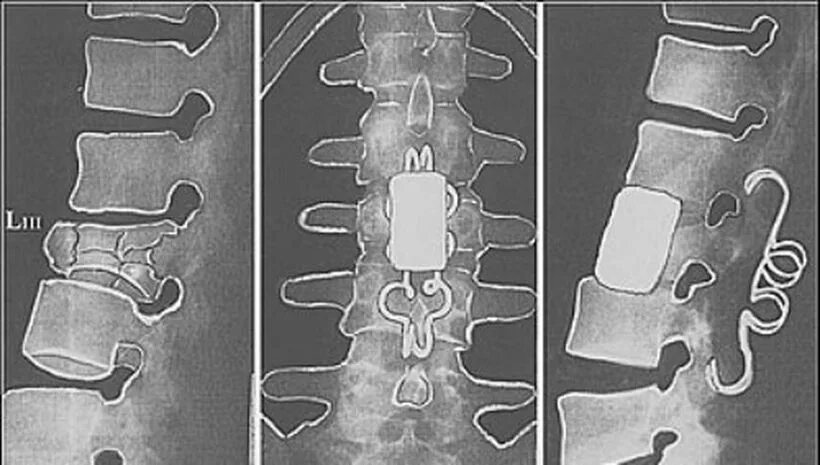 Компрессионный перелом тела l3 позвонка. Компрессионный перелом тела с4 позвонка. Компрессионный перелом тела л2 позвонка. Компрессионный перелом позвоночника л1.
