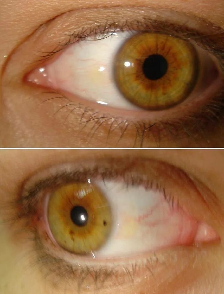 Что делать если желтые глаза