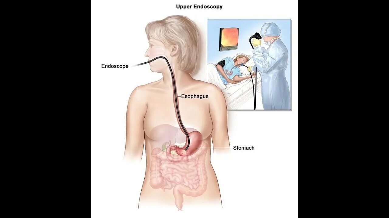 Пищевод без желудка. Гастроскопия. Методы обследования пищевода. Методика исследования пищевода.