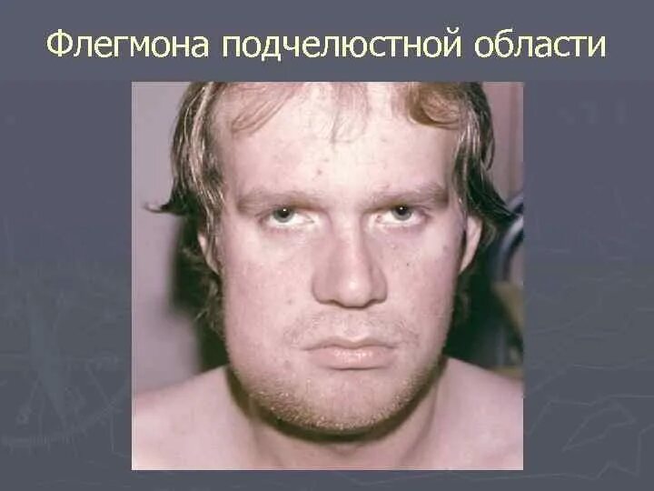 Выражен отек мягких тканей