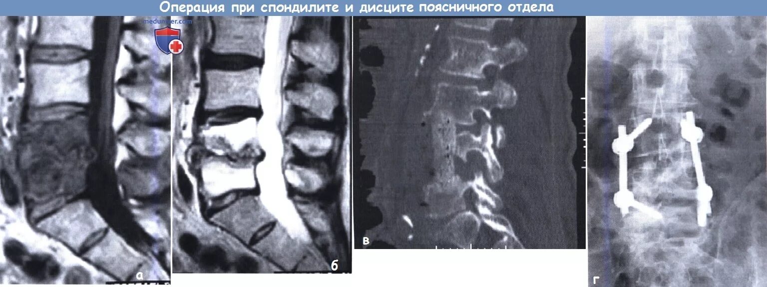 После операции на крестцовый отдел позвоночника. Спондилит l4-l5. Асептический спондилит l5-s1. Асептический спондилит с5-с6. Спондилит поясничного отдела кт.