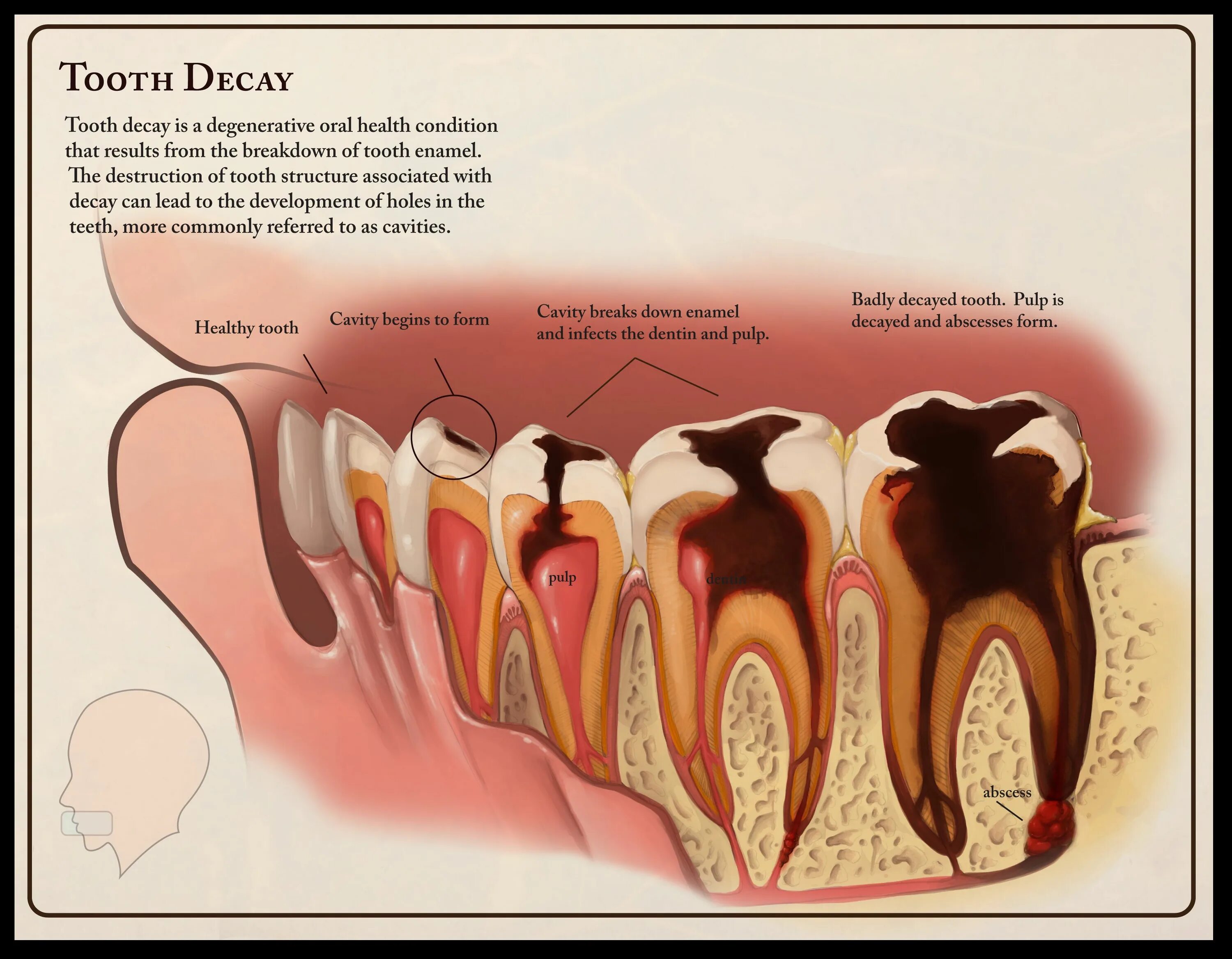 Почему жую зубы. Пришеечный кариес клыка. Полностью разрушенный зуб.