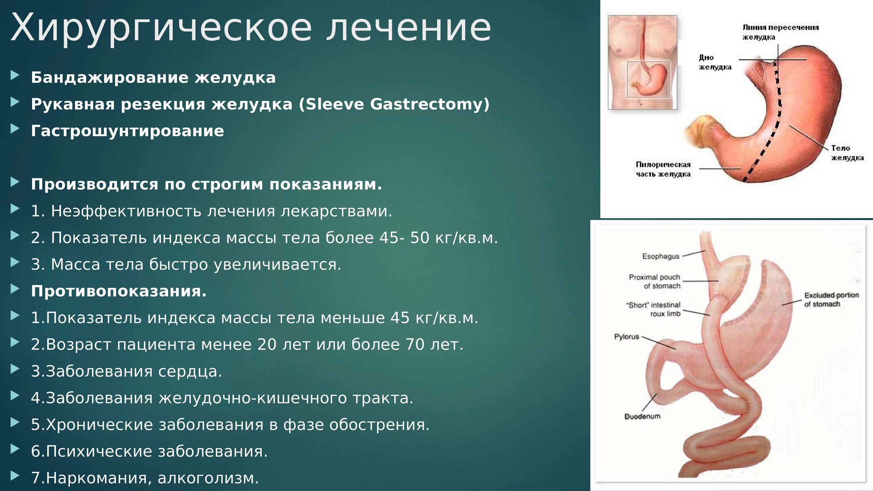 Последствия операции желудка. Рукавная резекция желудка. Продольная резекция желудка (Sleeve). Продольная (рукавная) резекция желудка. Гастрошунтирование гастрошунтирование желудка.