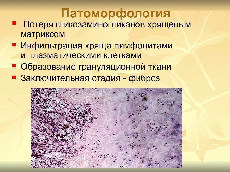 Диффузное соединительных тканей