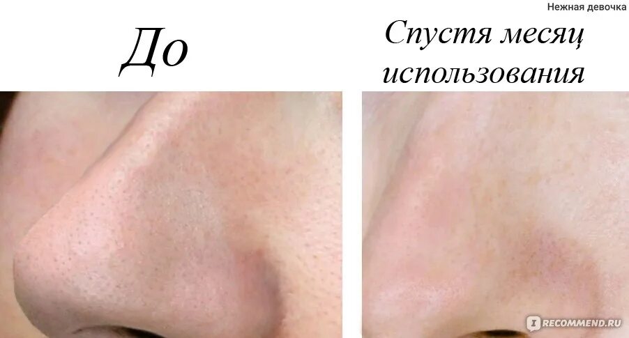 Причина пор. Сужение пор на лице до и после.