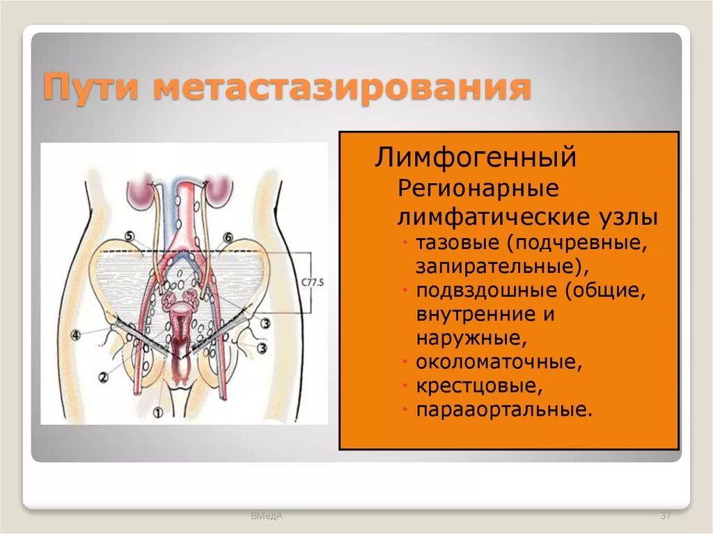 Тазовые лимфатические узлы. Подвздошные лимфоузлы. Запирательные лимфатические узлы. Наружные и внутренние подвздошные лимфатические узлы. Тазовая лимфаденопатия