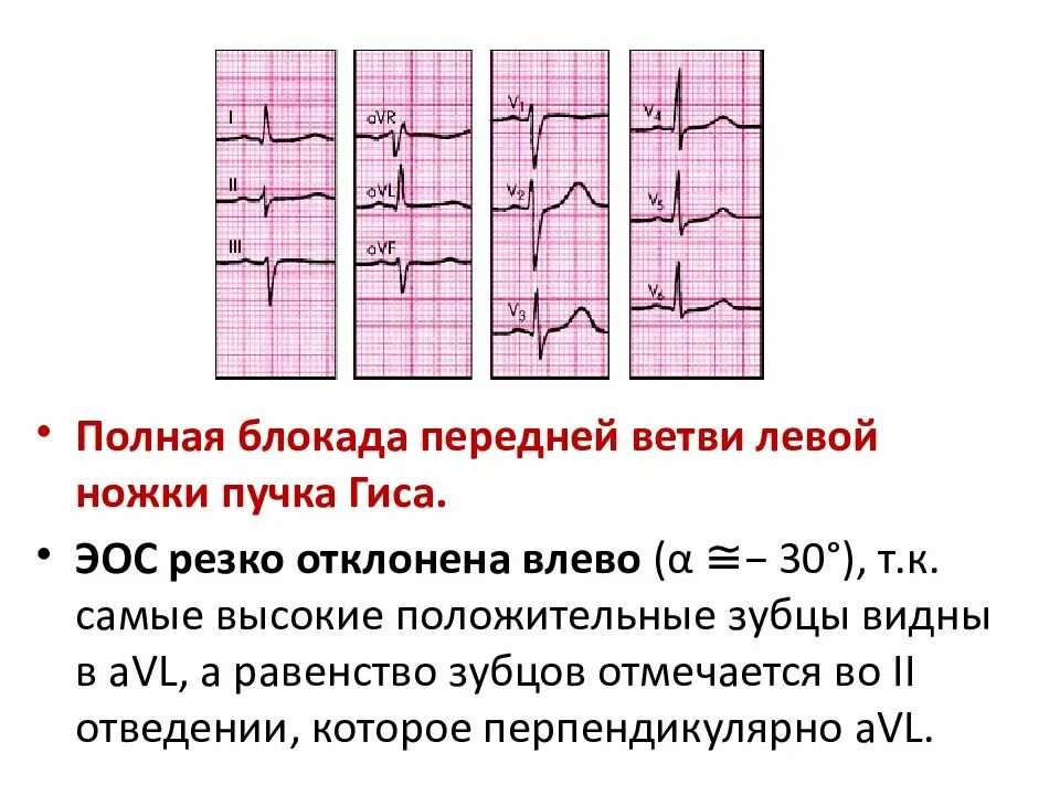 Блокада левой ножки пучка гиса на экг. Неполная блокада передней ветви левой ножки пучка Гиса на ЭКГ. Неполная блокада передней ветви ЛНПГ на ЭКГ. Блокада передней ветви ЛНПГ на ЭКГ. Блокада задней ветви ЛНПГ на ЭКГ.