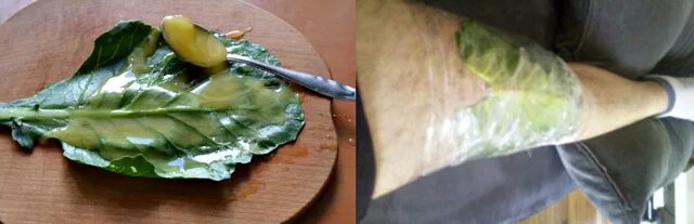 Капустный лист при артрозах. Компресс с капустным листом. компресс из капустных листьев. капустный лист прикладывают.