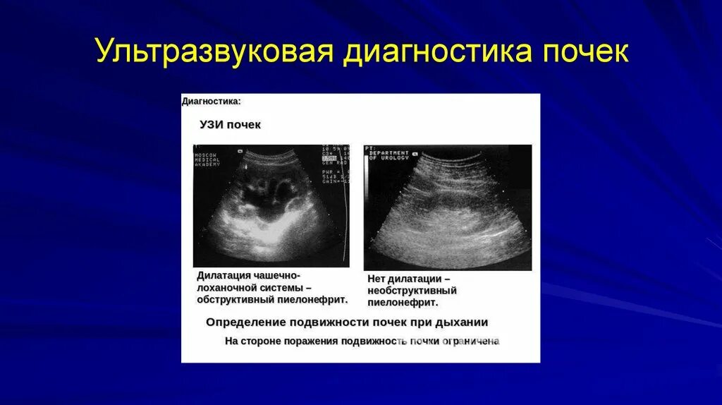 Узи почек диагнозы. УЗИ почек. Ультразвуковая диагностика почек. Обструктивный пиелонефрит на УЗИ. Нормальная почка на УЗИ.