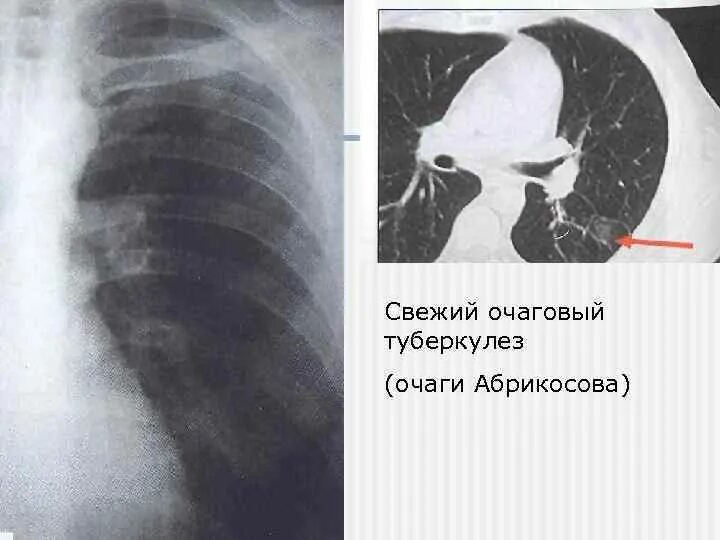 Очаг симон. Очаг гона очаг абрикосова. очаги симона при туберкулезе. очаг абрикосова – острый очаговый вторичный туберкулез.. очаг ашоффа пуля на рентгене.
