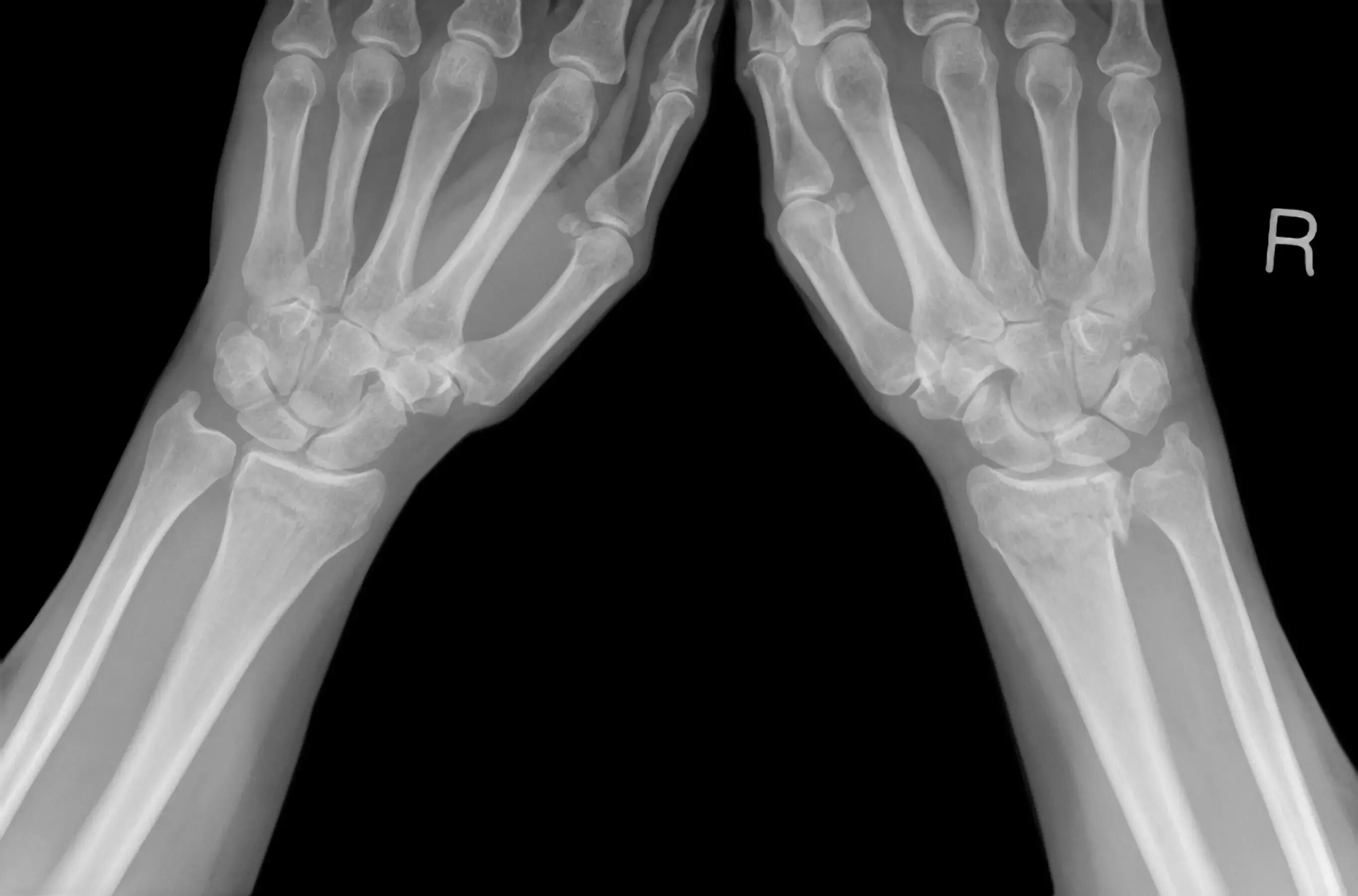 Перелом лучевой кости руки. Перелом лучевой запястной кости. Перелом лучевой кости рентгенограмма. Перелом лучевой кости в типичном месте РЕН.