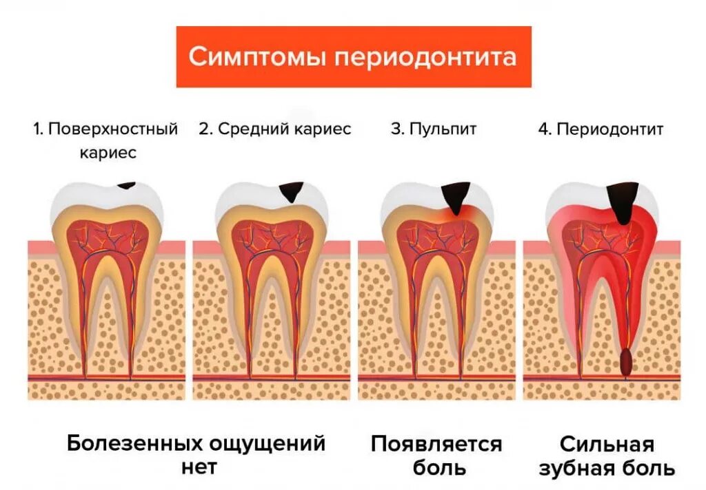 Кариозные поражения зубов.