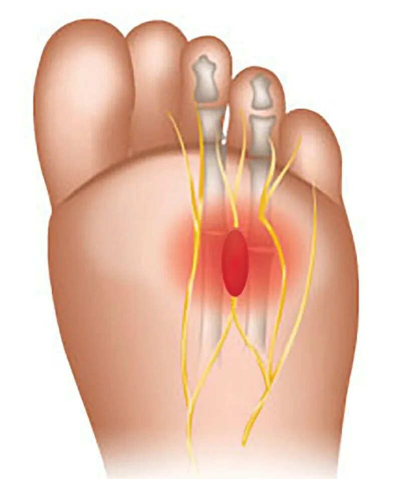Метатарзалгия неврома Мортона. Невринома Мортона стопы. Синдром Мортона неврома Мортона.