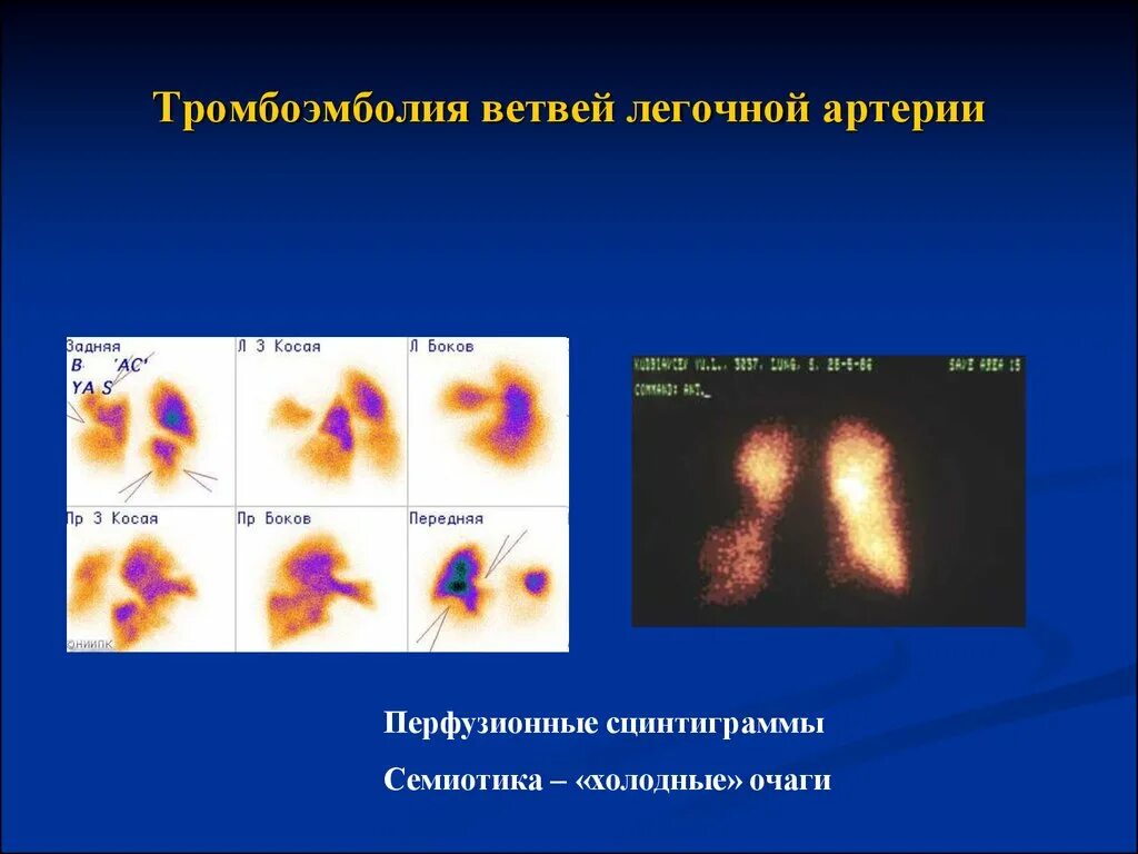 После тромбоэмболии легочной артерии. Эмболия легочной артерии сцинтиграфия. Тромбоэмболия легочной артерии сцинтиграфия. Тромбоэмболия ветвей легочной артерии. Эмболия ветвей легочной артерии.