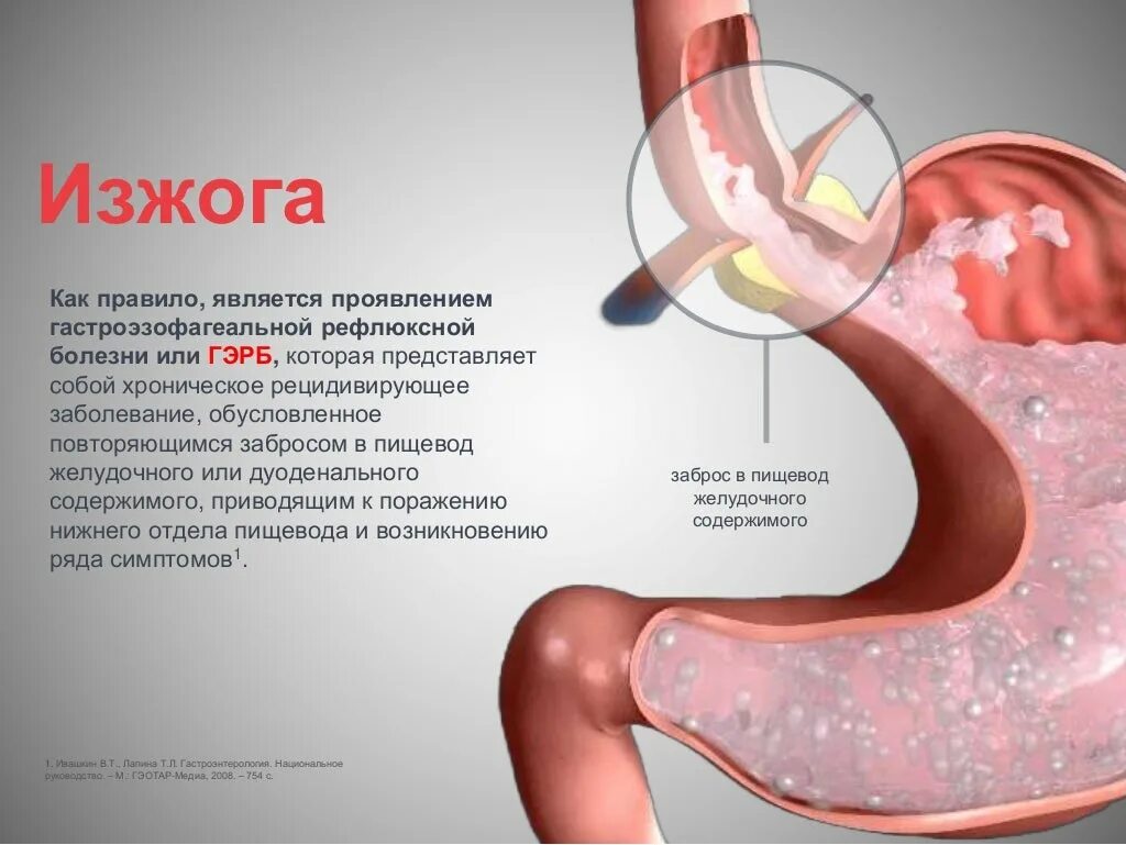 Изжога симптомы причины. Почему часто изжога