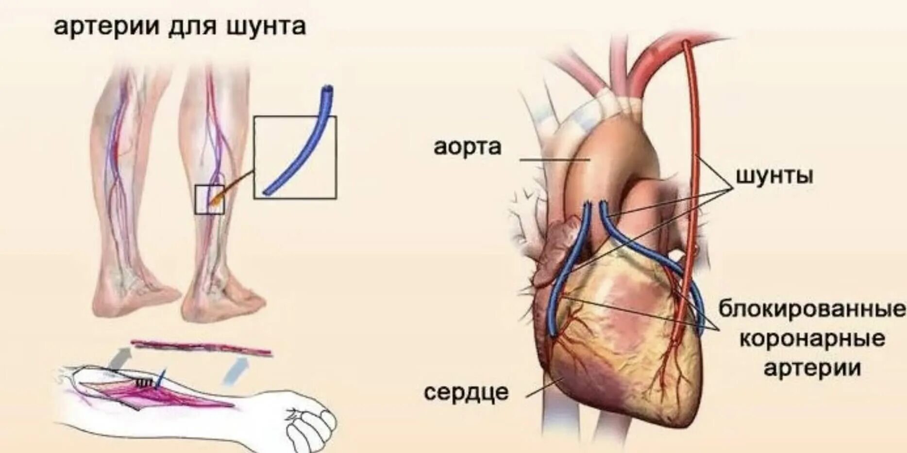 Операция коронарных сосудов. Аортокоронарное шунтирование схема операции. Шунтирование сосудов при инфаркте миокарда. Коронарное шунтирование сосудов сердца. Операция шунтирование сердца инфаркт.