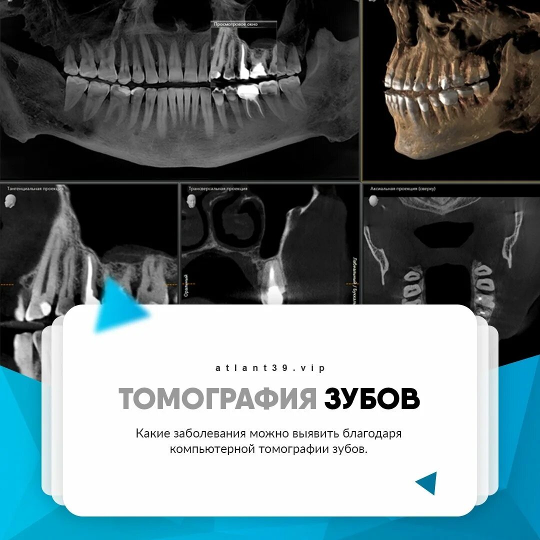 Где сделать кт зуба. Томография зубов. Кт зубов. Компьютерная томограмма зубов.