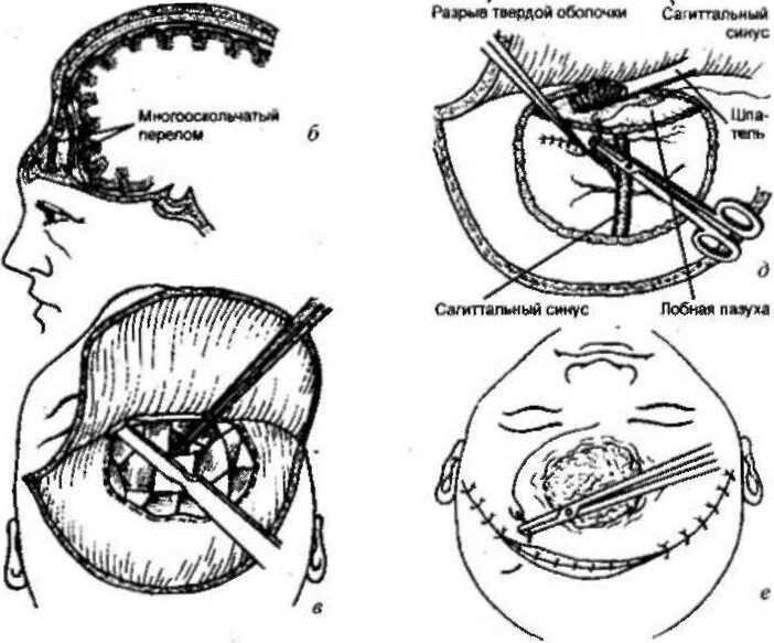 Для перелома основания черепа характерно. Перелом лобной кости операция. Веретенообразный перелом черепа. Перелом свода основания черепа. Трепанация черепа лобной кости.