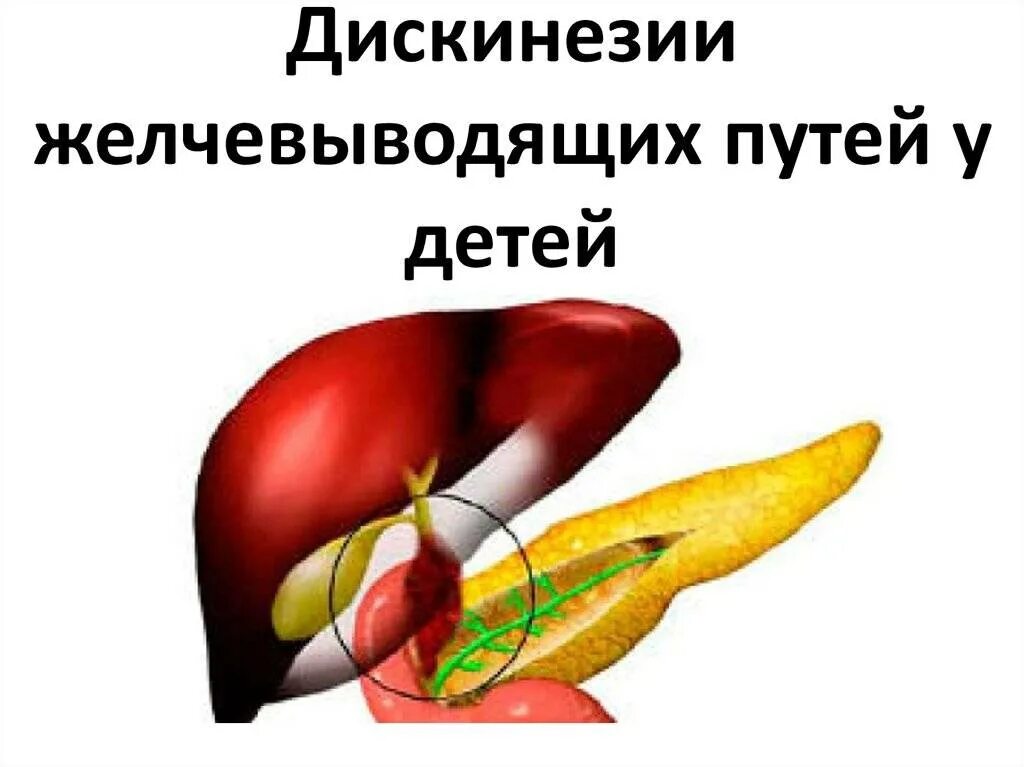 Джвп. Дискинезия желчевыводящих путей. Дискинезия ЖВП. Дискинезия желчных путей.