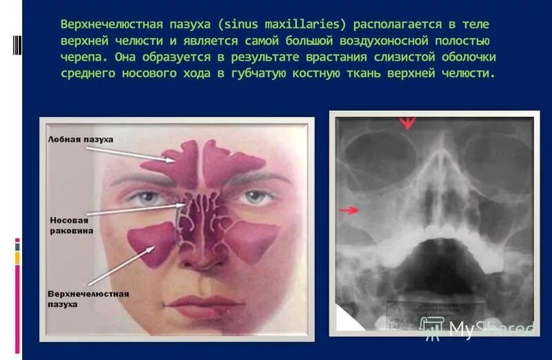 Пристеночный отек слизистой. Соустья гайморовых пазух. Стенки верхнечелюстной пазухи анатомия кт. Рентген анатомия верхнечелюстной пазухи. Базальная киста верхнечелюстной пазухи.