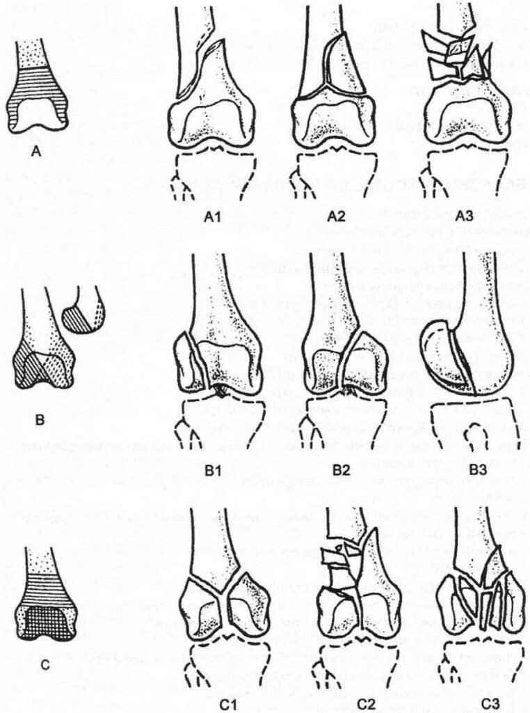Внутрисуставной перелом мыщелка. Перелом мыщелка бедренной кости классификация. Переломы мыщелков бедренной кости классификация. Перелом дистального отдела бедренной кости классификация. Классификация переломов дистального сегмента бедренной кости.