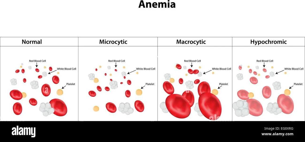 Mch анемия. Анемия рисунок. Анемия эритроциты. Эритроциты в крови анемия. Микроцитик анемия.