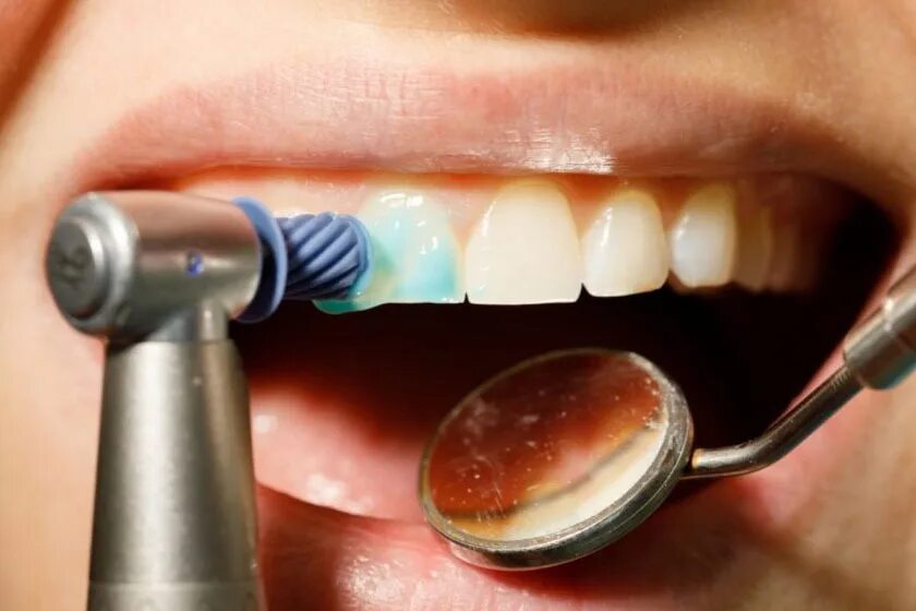 Чистка полировка зубов