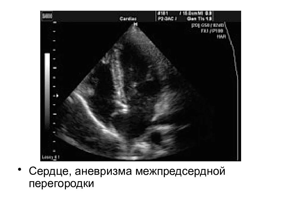 Аневризма перегородки у ребенка. Элонгация межпредсердной перегородки. Аневризматическое расширение межпредсердной перегородки. Аневризма межжелудочковой перегородки Эхо. Межпредсердная перегородка аневризма.
