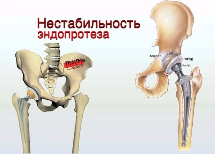 Гемиартропластика тазобедренного сустава. Нестабильность эндопротеза тазобедренного сустава кт. Эндопротез тазобедренного сустава кт. Эндопротезирование тазобедренного сустава вывих кт. Замена т б сустава