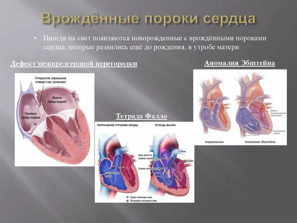 Врожденный порок сердца (ВПС). 3 Тип порока сердца у плода. Вражденный порог серца. Врожденный порог сердца.