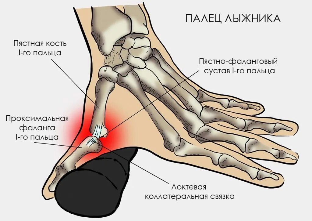 Растяжение капсульно-связочного аппарата на пальцах. Пастнофаланговый суства 1 пальца. Повреждение локтевой коллатеральной связки большого пальца. Разрыв локтевой коллатеральной связки.