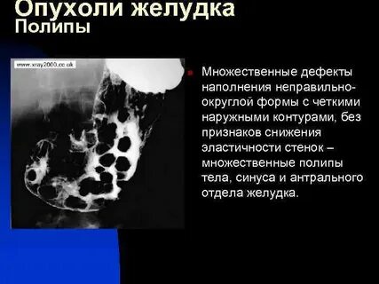 Рак желудка по утвержденным клиническим