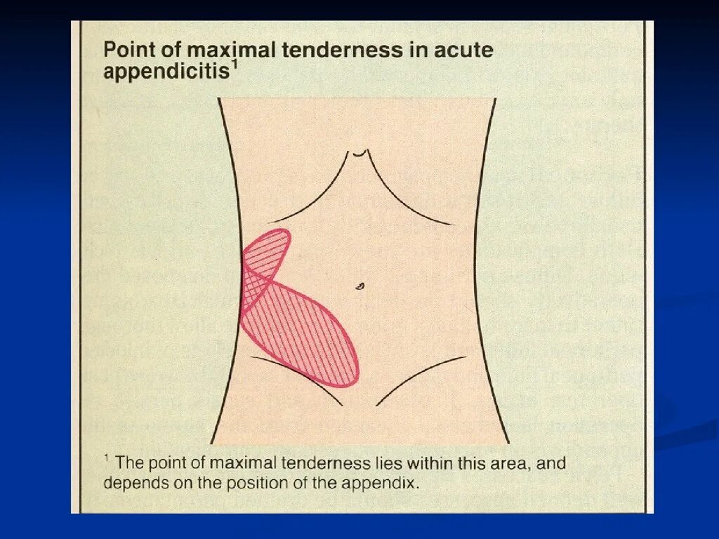 Аппендикс находится справа или слева. Локализация боли при аппендиците.