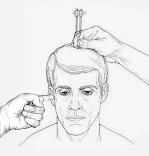 Ринне вебера