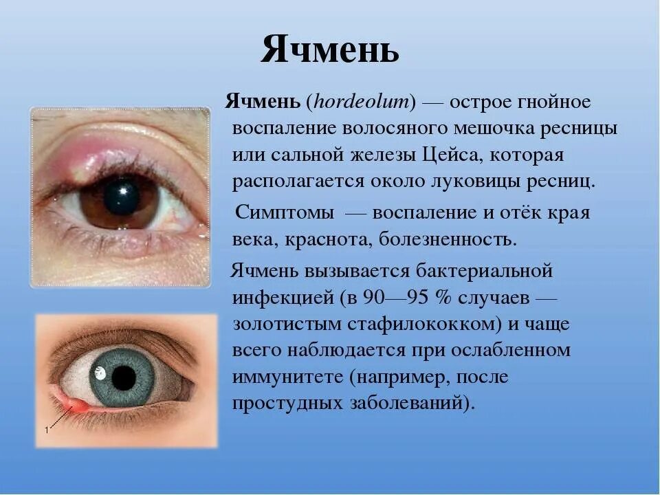 Как быстро вылечить ячмень у взрослого. Воспаление века ячмень. Глазное заболевание ячмень.