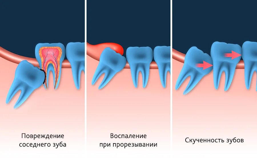 Удаленные зубы мудрости. Полуретинированный зуб мудрости. Зуб мудрости проростается. Когда в марте удалять зубы