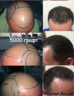 Сколько после пересадки волос